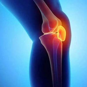 A skeleton of a knee with red and yellow highlighted.