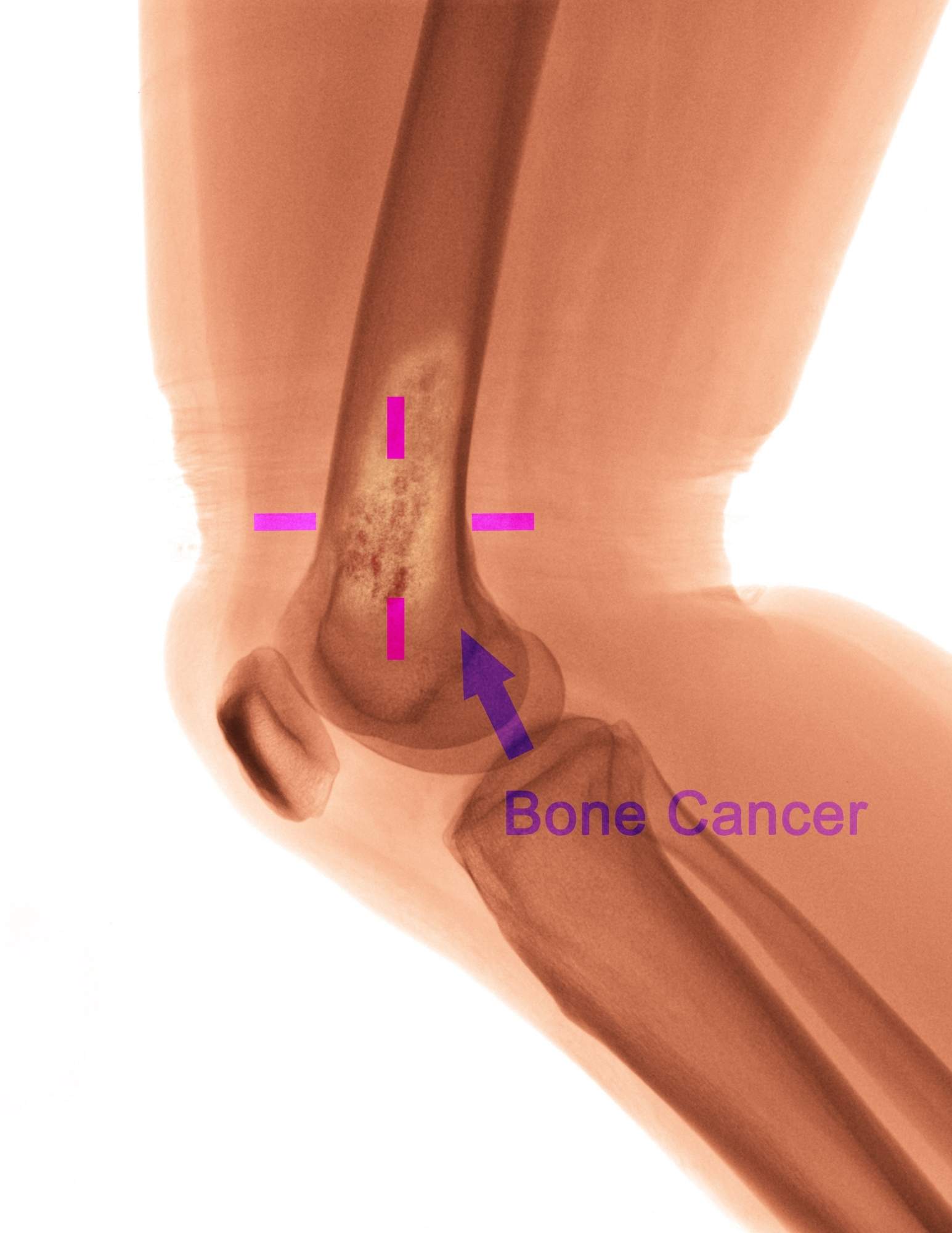 X-ray of a human knee.