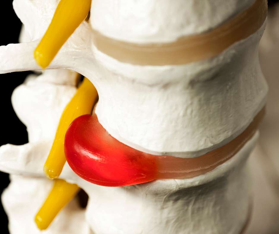 A model of a spine with a red ball on it.